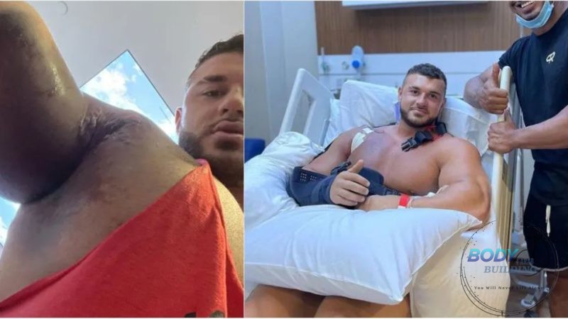 خضوع لاعب كمال الأجسام ريان كرولي Ryan Crowley لعملية جراحية ناجحة بعد إصابة عضلة الصدر المدمرة