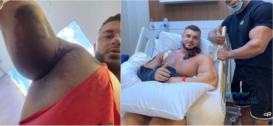 خضوع لاعب كمال الأجسام ريان كرولي Ryan Crowley لعملية جراحية ناجحة بعد إصابة عضلة الصدر المدمرة